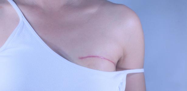 Lei de 1999 previa procedimento apenas para pacientes de câncer